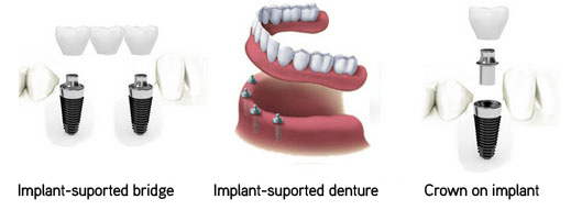 Cost of a dental implants at Helvetic Dental Clinics